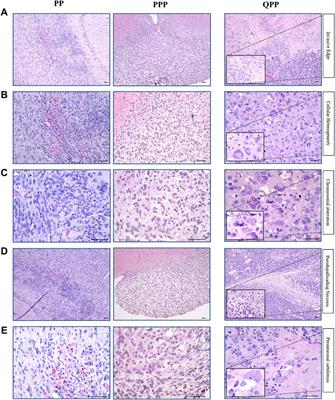 Quaking but not parkin is the major tumor suppressor in 6q deleted region in glioblastoma